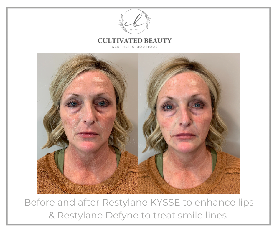 Before and After Restylane KYSSE & Defyne treatment on lips and Smile lines | Cultivated Beauty Aesthetic in Guntersville AL