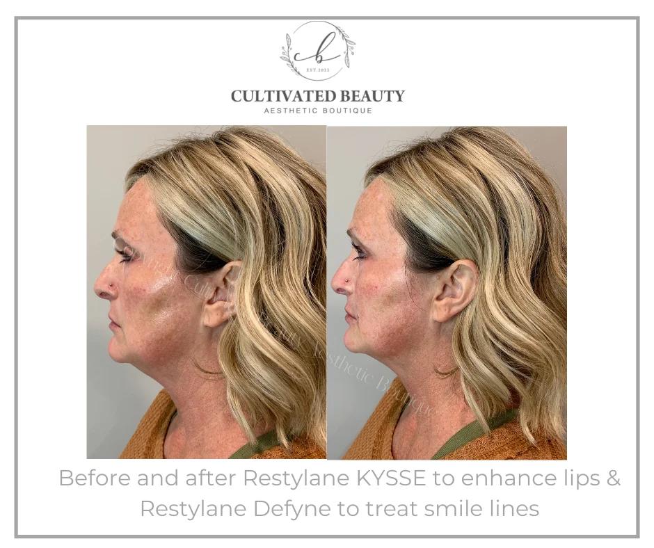 Before and After Restylane Kysse & Define treatment | Cultivated Beauty Aesthetic in Guntersville, AL