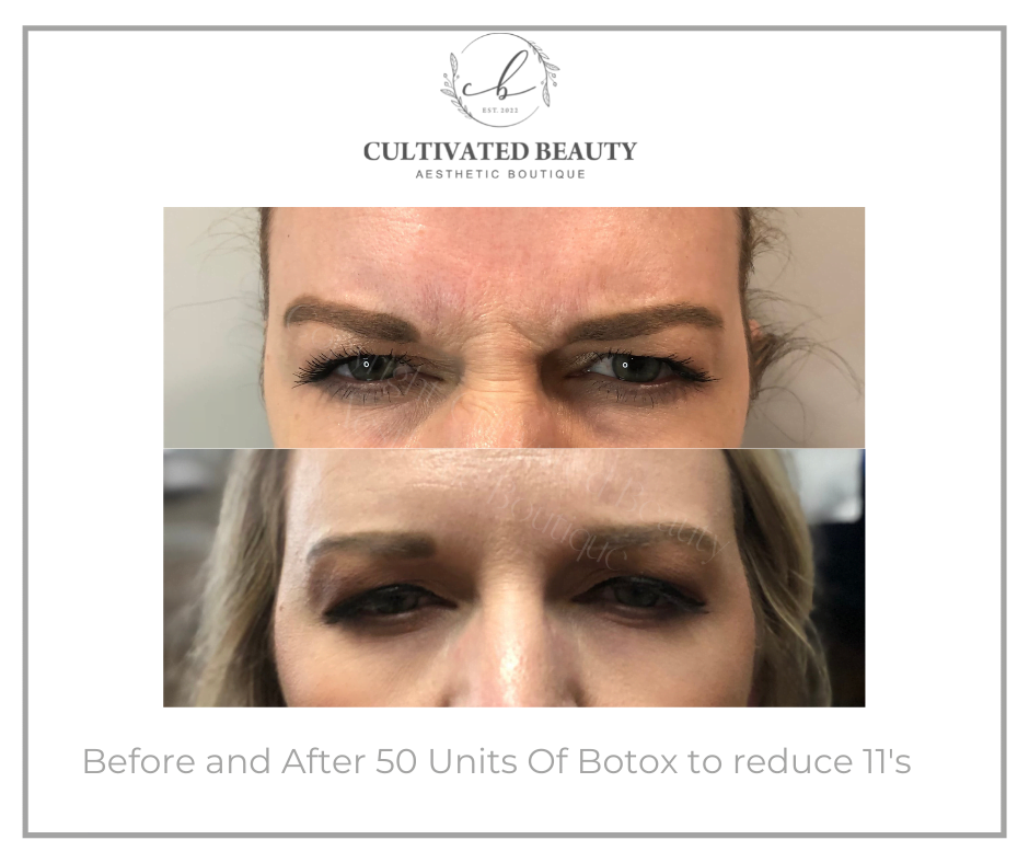 Before and After Botox treatment | Cultivated Beauty Aesthetic in Guntersville, AL