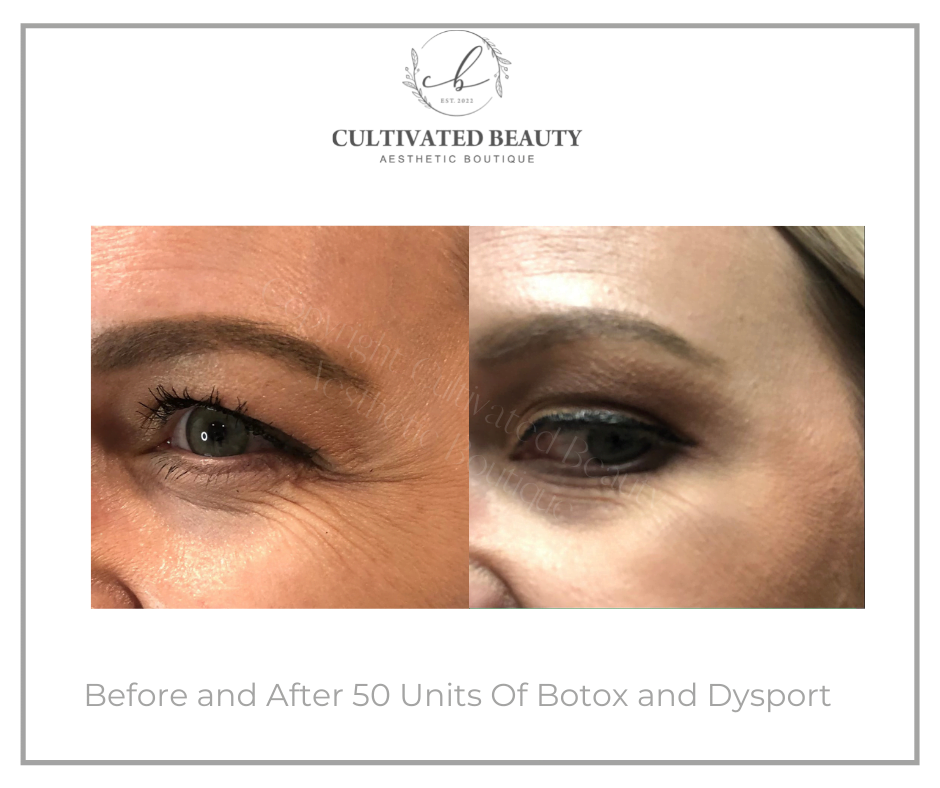 Before and After Botox and Dysport treatment | Cultivated Beauty Aesthetic in Guntersville, AL