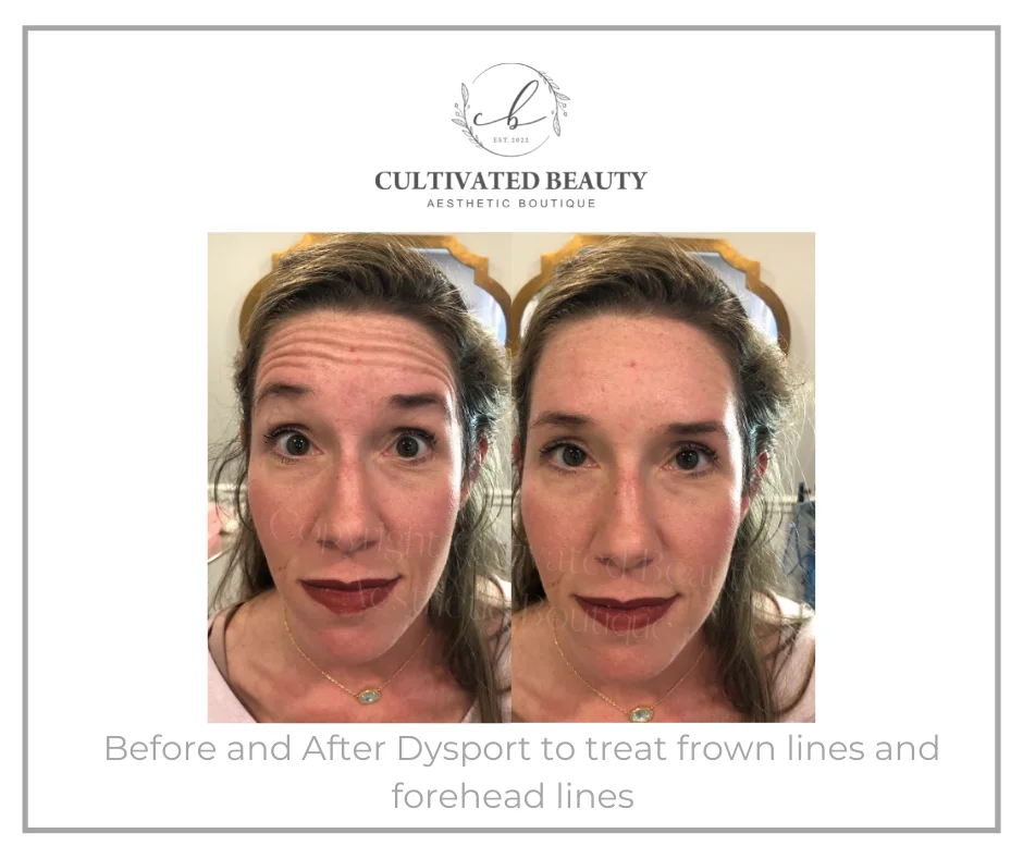 Before and After Dysport treatment | Cultivated Beauty Aesthetic in Guntersville, AL
