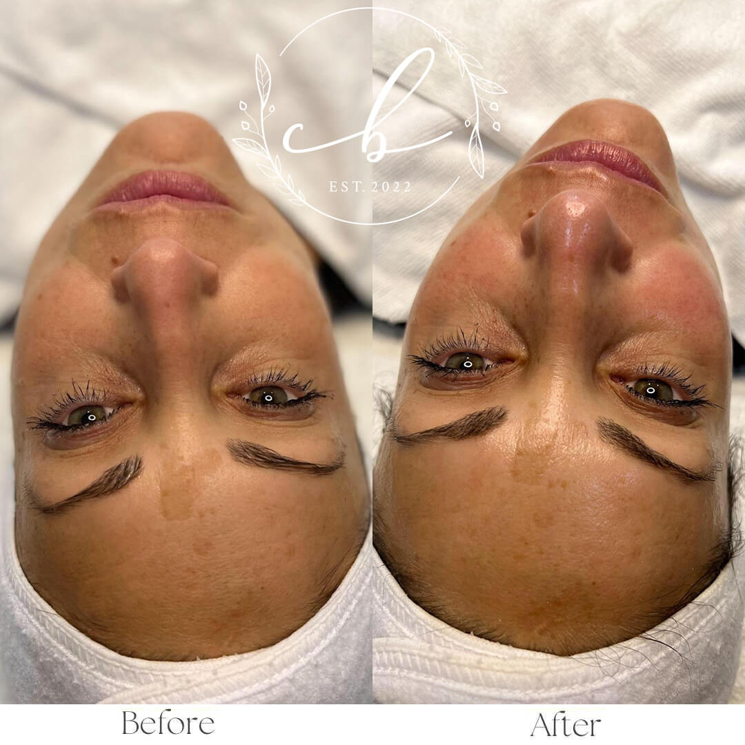 Before and After Chemical Peels treatment | Cultivated Beauty Aesthetic in Guntersville, AL