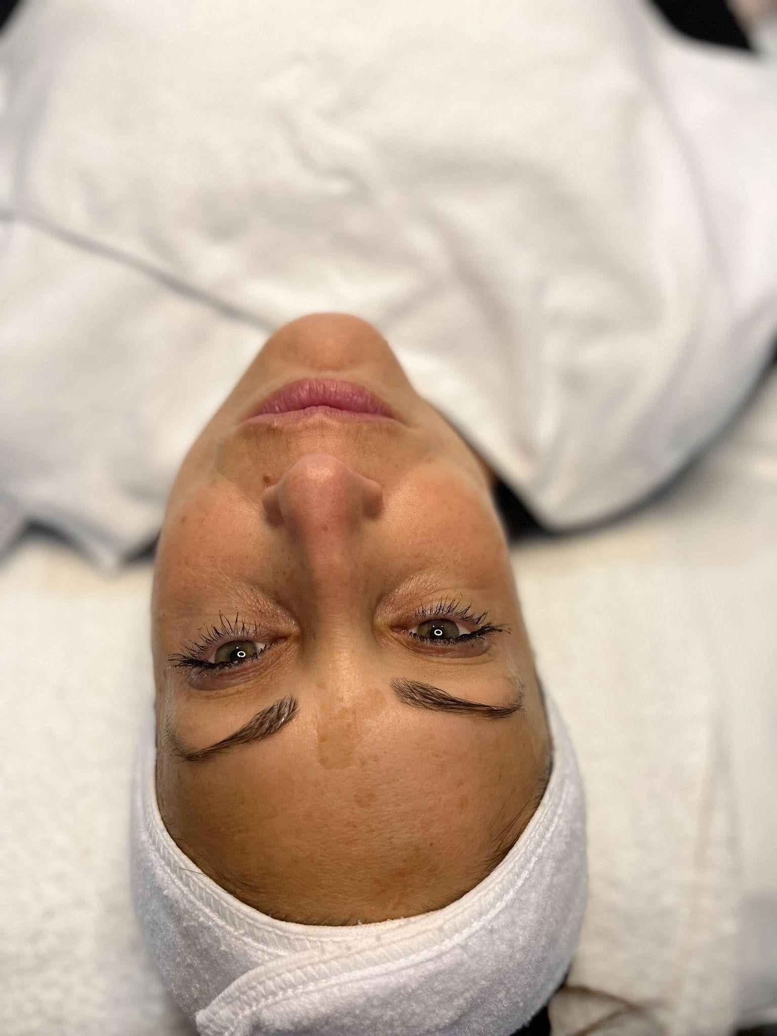 A Women's face before Chemical peels | Cultivated Beauty Aesthetic in Guntersville, AL
