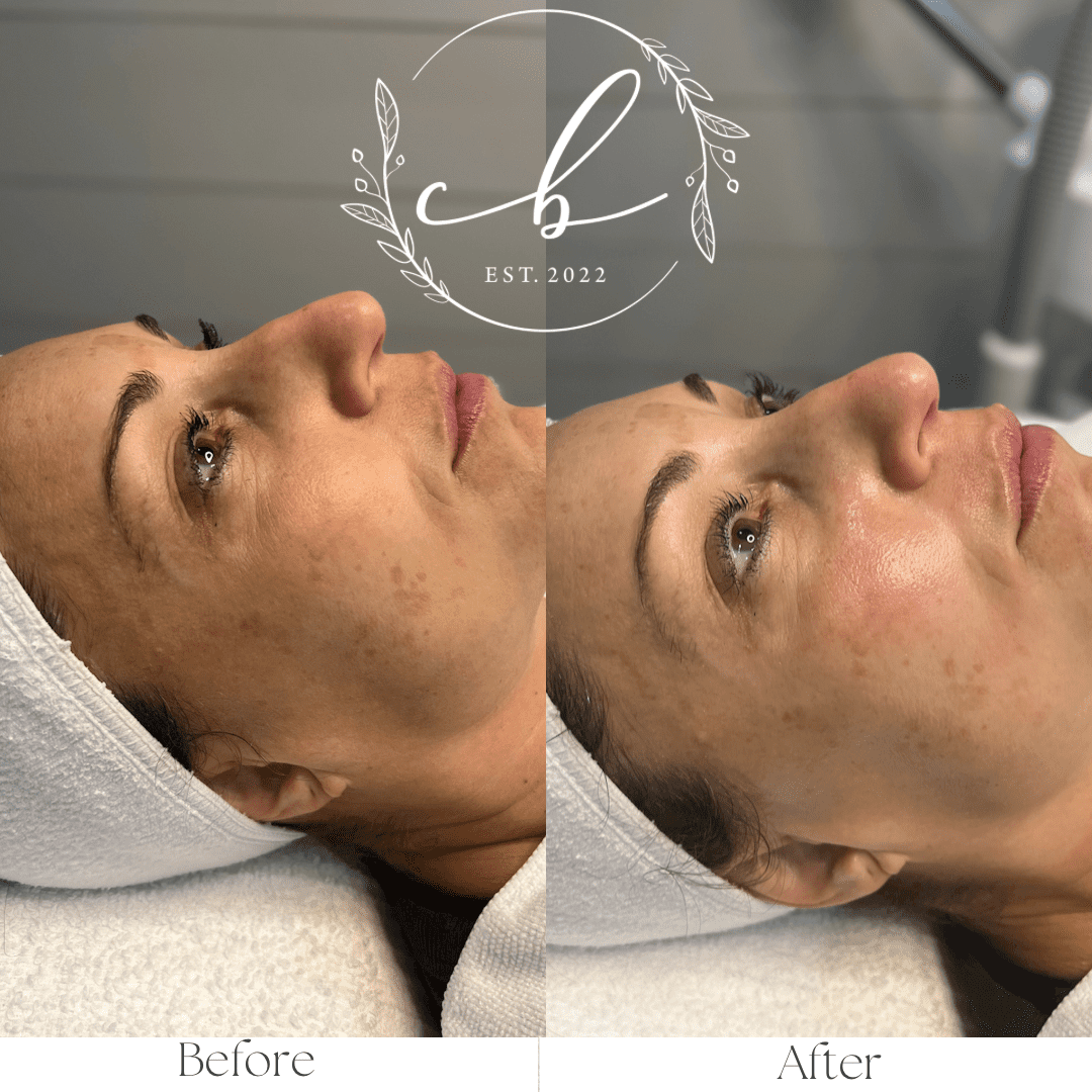 Before and After Chemical Peels treatment | Cultivated Beauty Aesthetic in Guntersville, AL