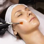 Chemical Peel Treatment by Cultivated Beauty Aesthetic in Guntersville AL