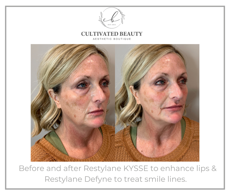 Before and After Restylane Kysse & Define treatment | Cultivated Beauty Aesthetic in Guntersville, AL