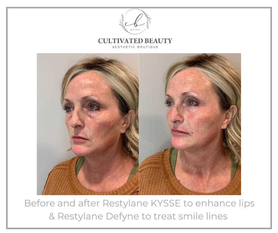 Before and After Restylane Kysse & Define treatment | Cultivated Beauty Aesthetic in Guntersville, AL