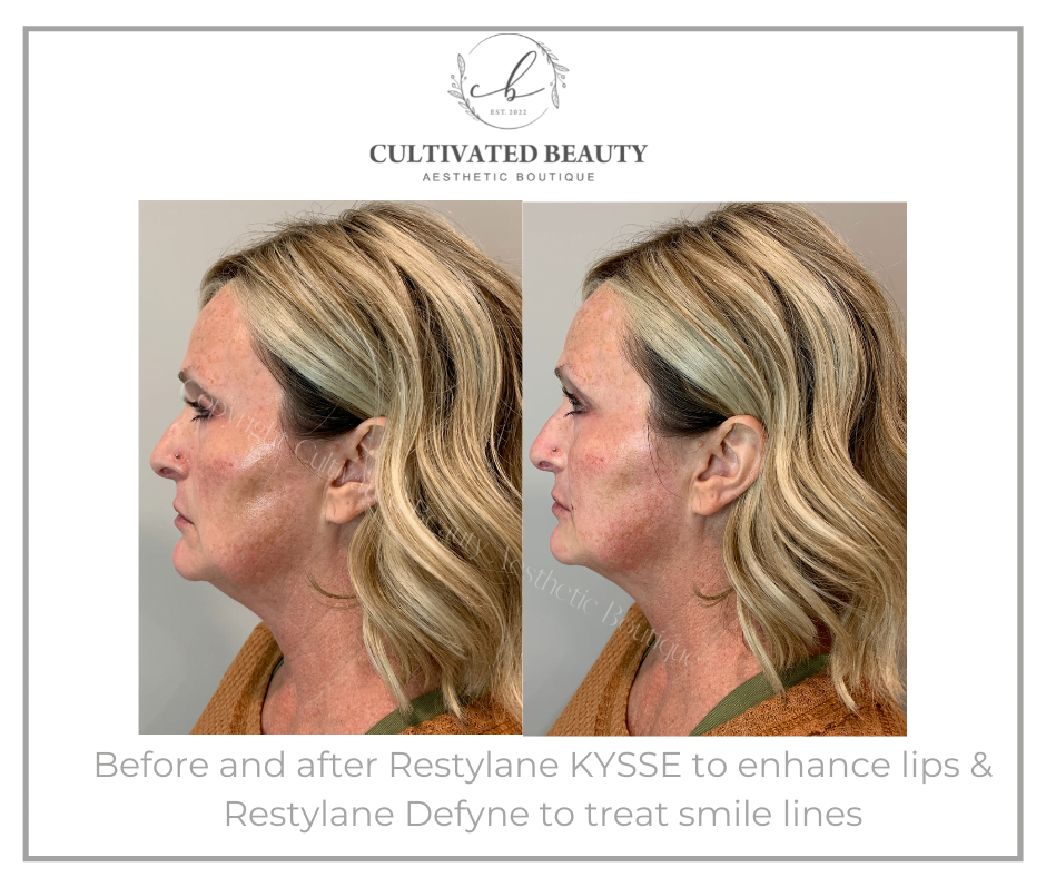 Before and After Restylane KYSSE & Defyne treatment on lips and Smile lines | Cultivated Beauty Aesthetic in Guntersville AL
