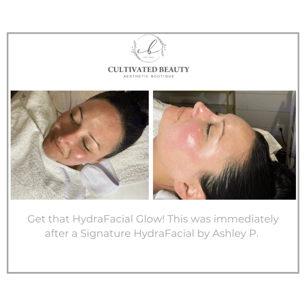 Before and After HydraFacial treatment | Cultivated Beauty Aesthetic in Guntersville, AL