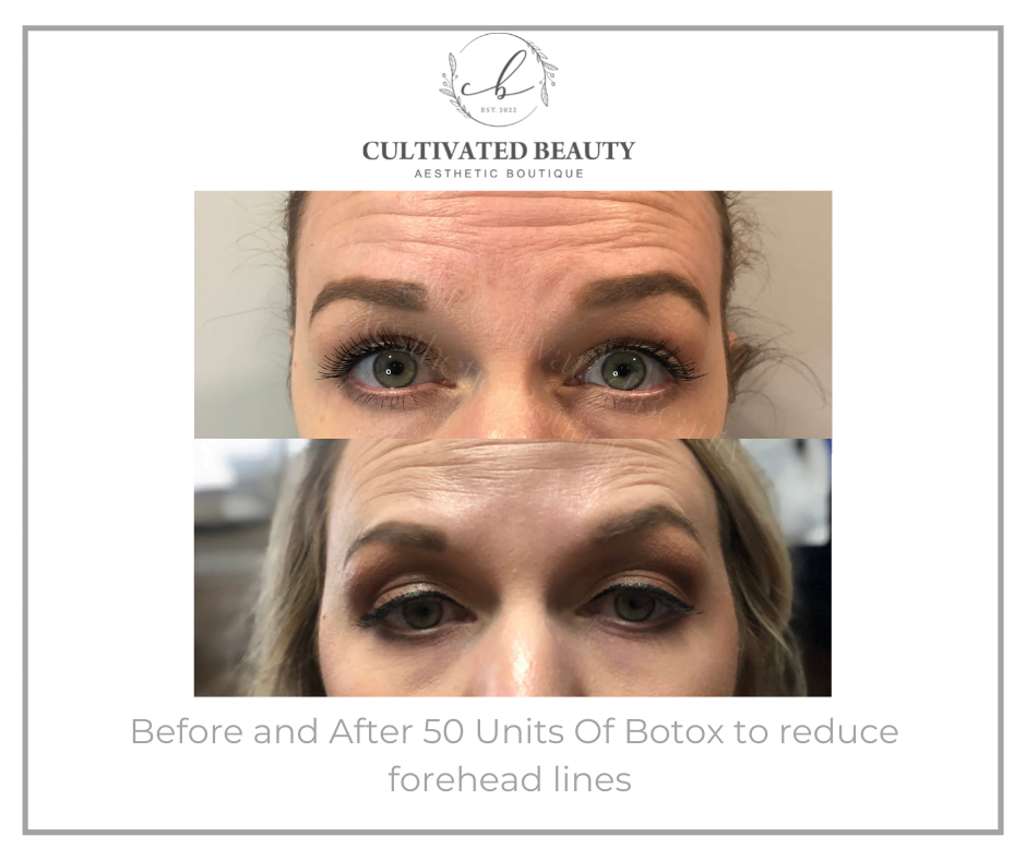 Before and After Botox treatment on forehead lines | Cultivated Beauty Aesthetic in Guntersville, AL