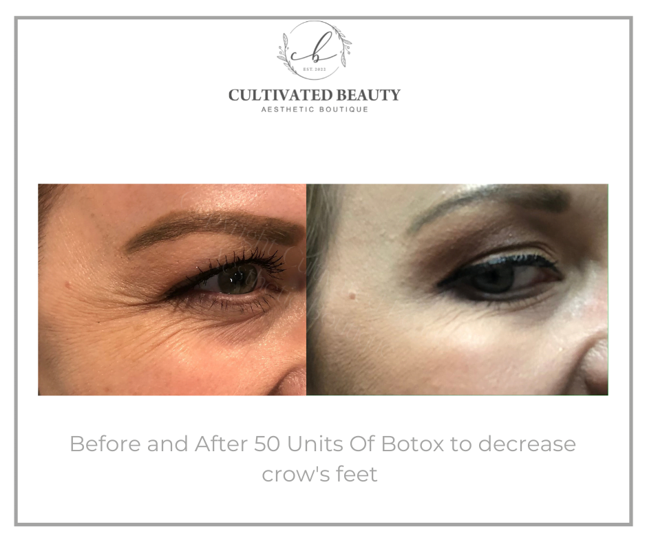 Before and After Botox treatment | Cultivated Beauty Aesthetic in Guntersville, AL