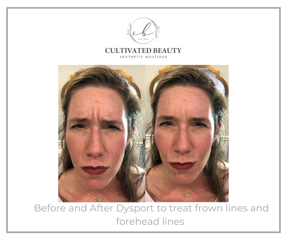 Before and After Dysport treatment | Cultivated Beauty Aesthetic in Guntersville, AL