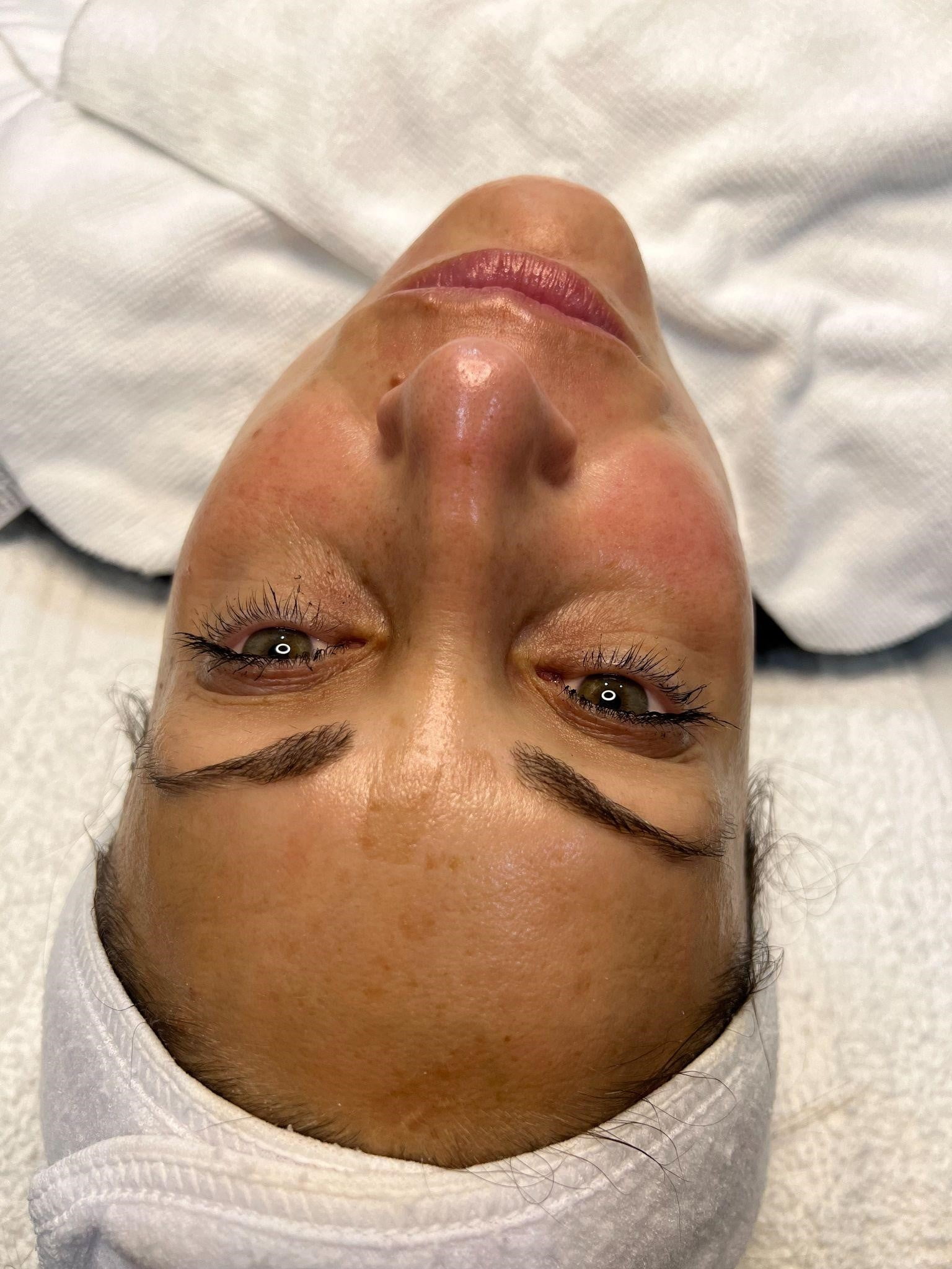 A Women's face after Chemical peels | Cultivated Beauty Aesthetic in Guntersville, AL