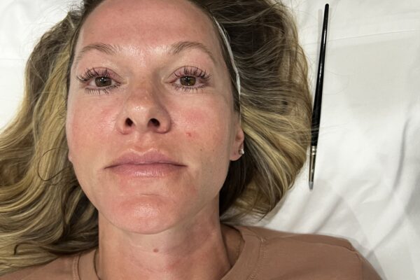 A Woman face after PRX T33 Peel treatment | Cultivated Beauty Aesthetic in Guntersville AL