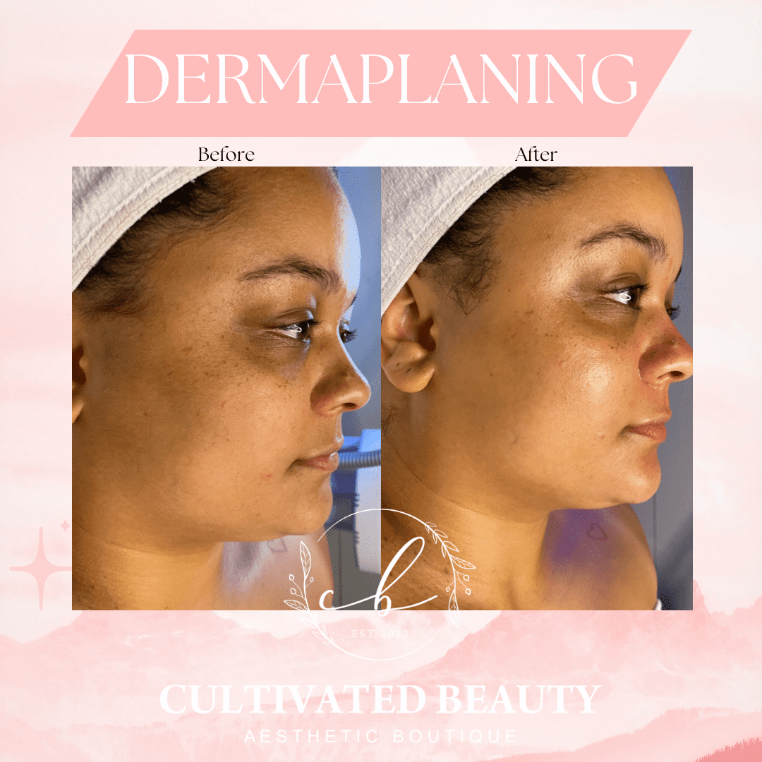 Before and After Dermaplanning treatment | Cultivated Beauty Aesthetic in Guntersville, AL